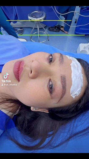 #eyebrow lift #lower eyelid surgery with hidden threads #beautiful eyes@người theo dõi | Nhật Hà Plastic Surgery