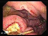 Presence of Multiple Irregular and Large Ulcers - 44 Years-Old Male • Video • MEDtube.net