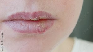 Close up of girl lips affected by herpes. Treatment of herpes infection and virus. Part of young woman face, lips with herpes affected. Beauty dermatology concept