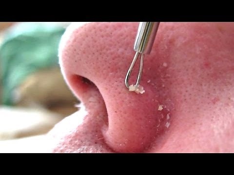 3B of 4 Removing Blackheads & Whiteheads Using A Comedone Extractor Tool HD