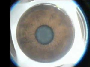 Hyperopic LASIK the introduction of Topography-guided ablation, Kanellopoulos, MD