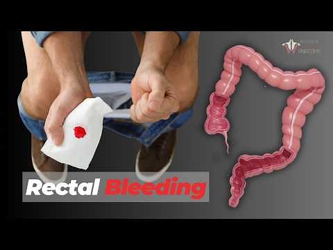 When to Be Worried About Rectal Bleeding