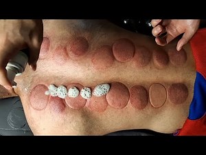 "Deep Relaxing ASMR Cupping Massage"