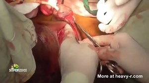 Fixing Degloved Penis