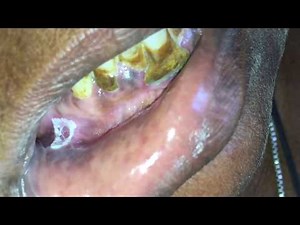 Leukoplakia#Smokers Keratosis