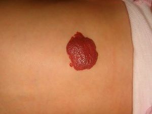 Infantile hemangioma