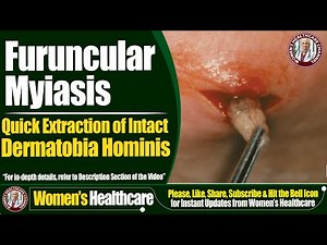 Furuncular Myiasis | Quick Extraction of Intact Dermatobia Hominis | Women's Healthcare
