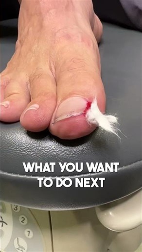 How To Treat an Ingrown Toenail 🦶