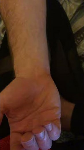 Ulnar styloid process