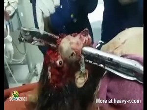 Young Woman Impaled By Metal Rail
