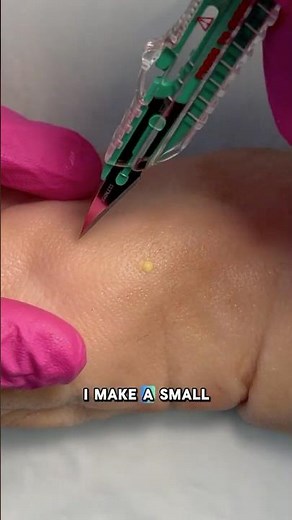 Abscess incision & drainage Technique ✅ #pastudent #npstudent #howtostich #stitches #howto