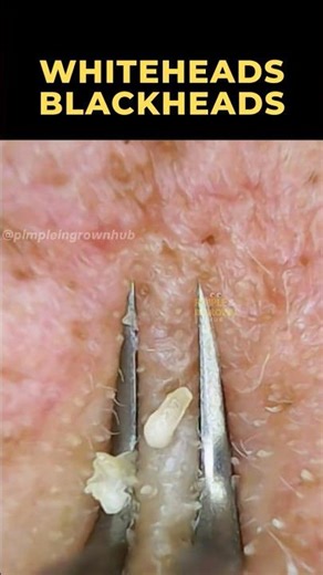 Whitehead & Blackhead Explosion 🤯 So Satisfying!