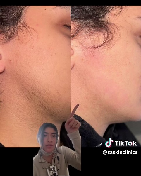 Electrolysis results after 2 sessions: permanent hair removal proof