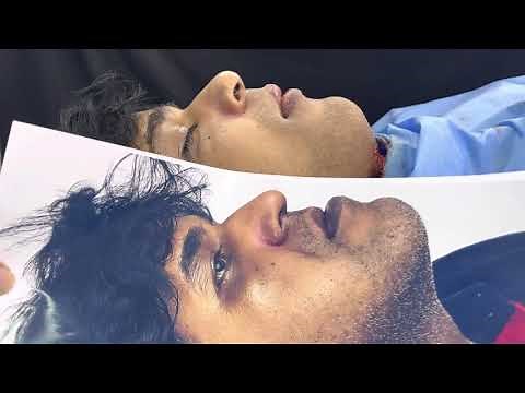 Before and after Bimax Orthognathic Surgery in India by Best Experienced Jaw Surgeon