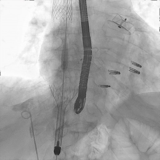A 74-year-old man was referred for residual tricuspid regurgitation after transcatheter edge-to-edge repair (TEER) ➡️ not a surgical candidate ➡️ caval valve implantation ➡️ may be a valuable bailout strategy after TEER failure. Learn more in #JACCCaseReports: https://bit.ly/3NAG1Hs | JACC Journals
