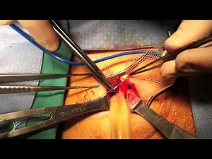 Inguinal (Groin) Hernia Repair with Mesh Placement, Darrin Hansen MD, Salt Lake City, Utah