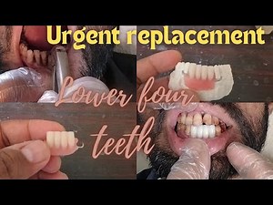 Front lower teeth replacement | tooth extraction | partial tooth replacement