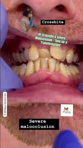 🔁 Crossbite & Severe Malocclusion – Time for a Transformation!