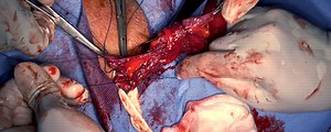 Right Open Indirect Inguinal Hernia Repair and Radical Inguinal Orchiectomy | Journal of Medical Insight
