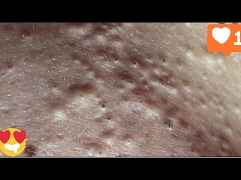 The Back Is Full Of Blackheads #pimple #blackheadremoval #acne #removal