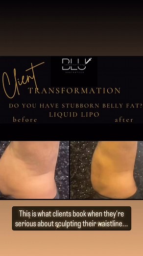 ⚡️Client Transformation ⚡️ 💉Liquid Lipo is trending for a reason when paired with lifestyle habits, the results show up fast. Every body is unique, and every plan is customized at Blu Innovation.. Ready for your own plan? Click my bio link. Tiffany Franklin, FNP-C 📍Blu Innovation | Matthews Aesthetic NP 📞(336) 705-19731 📧info.blu.vi@gmail.com #LiquidLipo #MatthewsAestheticNP #MatthewsNC #CharlotteAesthetics #BeforeAndAfterResults | Blu Innovation