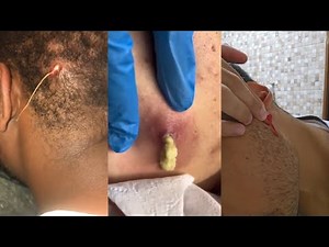 Satisfying Pimples Pop | Cyst Removal | Acne | Blackheads - Pimple Popping Compilation Videos #14