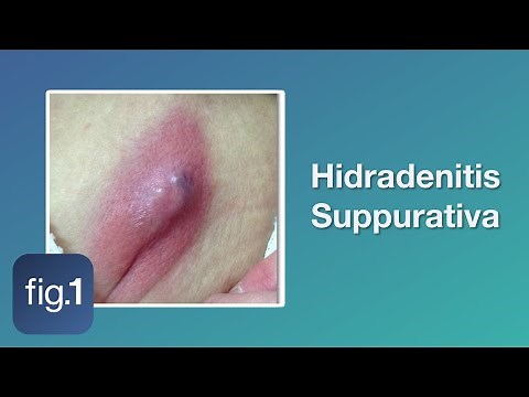 What is Hidradenitis Suppurativa?
