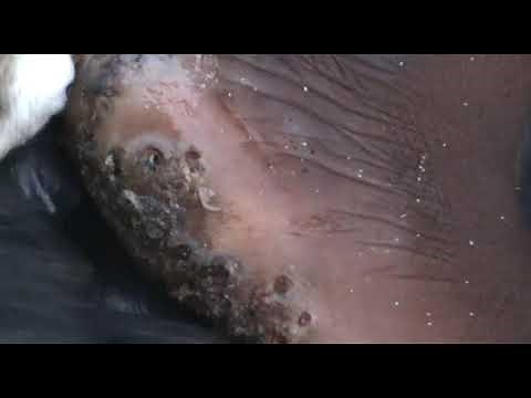 Moses' Feet Covered in Jigger Eggs - The Last Straw