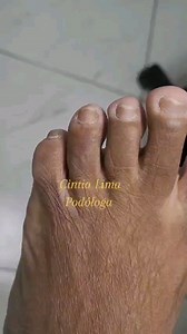 Podoprofilaxia, procedimento onde o podólogo trata as alterações superficiais dos pés. Podologia é saúde e bem estar. Informações sobre agendamento e Cursos pelo WhatsApp: (21) 97923-2275 #podologiainfantil #protese #podologia #spadospes #pedicure #podologo #podologa #SUS #manicure #saude #unhas #estética #podiatry #foot #órtese #reflexologiapodal #curso #fissura #pesrachados #ozonio #resina #micosedeunha #podopatias #viral #espiculaecmia #granuloma #aula #aulapratica #ortese #saudeospes | Anchi