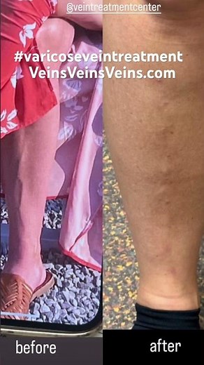 #varicoseveintreatment with phlebectomy