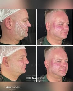 FACELIFT NECKLIFT with THREADS by @drhurayhugul ✅Only one day procedure ✅Virtually painless ✅Comfortable ✅Satisfying ✅Long-Term Results ✅PCL/PLLA Threads: 2-3 years ✅Permanent Threads: 5-8 years Do not hesitate to contact us; We will help you with PLEASURE ☎️ 90242 324 00 03 ☎️ 90545 404 72 22 ☎️ 90545 494 72 22 You can write from DM 🥰🥰🥰 #drhürayhügül #threadlifting #facelift #necklift #faceliftturkey #нити #французкинити #бесконечныенити Photographs are not filtered. All patients gave consen