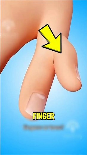 Born With an Extra Finger Here’s Why It Happens (Polydactyly Explained) #shortsviral