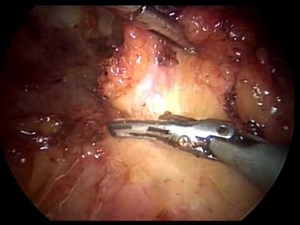 Inguinal Lymphadenectomy (LEG Procedure) - Endoscopy • Video • MEDtube.net