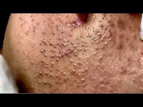 Tokyo Acne Treatment Blackhead Extractions Popping #2
