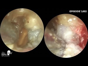 1,652 - Malignant Otitis Externa Patient Attends for Ear Microsuction