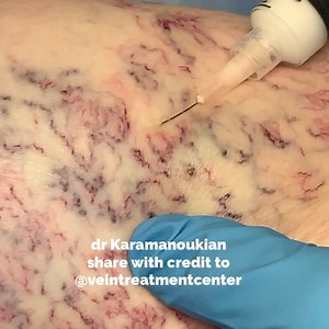 Sclerotherapy. @veintreatmentcenter on Instagram www.VeinsVeinsVeins.com/contact/ | Vein Treatment Center | Facebook