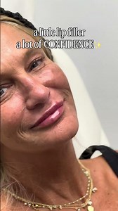 Natural Lip Filler Before and After in San Diego | Subtle Confidence Boost ✨
