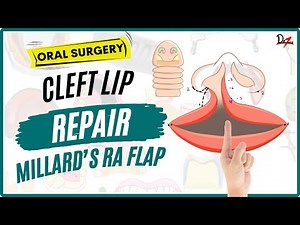 Cleft Lip Repair - Millard's Rotation Advancement Flap