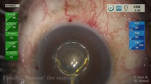 Cataract Surgery with Zepto and MIGS - Eyetube