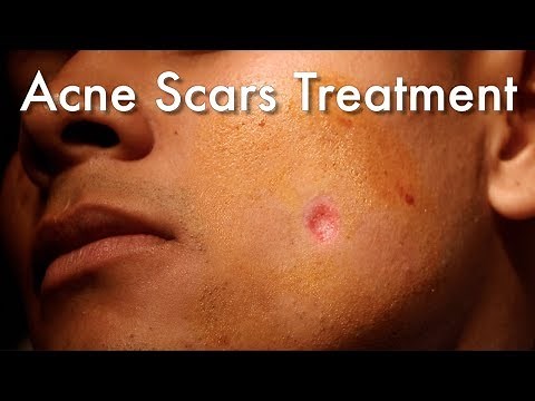 Dermabrasion For Acne Scars