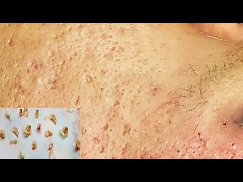Enlever les boutons sous la peau du visage | acne extraction