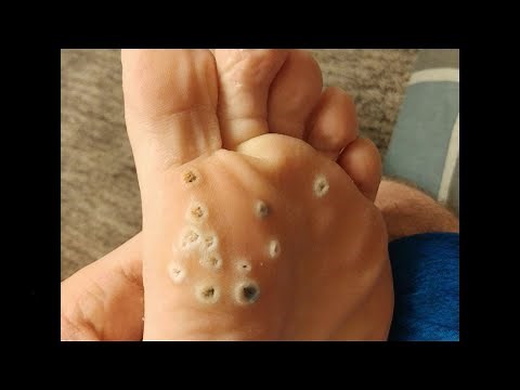 Plantar Wart Removal! How to Remove Plantar Warts!