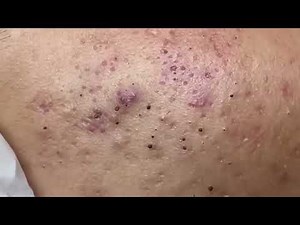 The Ultimate Blackhead Removal Guide: Clear Skin Secrets! ‪@removeblackhead‬