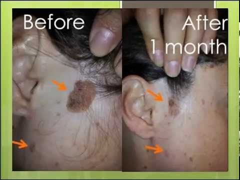 Natural treatment for seborrheic keratosis before and after photos