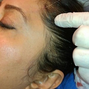 1.1K views · 11 reactions | BROW LIFT WITH THREADS. The #PLLA Spiral #Cog #Thread #BrowLift is a treatment that helps lift and tighten skin tissue in the forehead directly around the eyebrows to provide a nonsurgical browlift. | American Aesthetic & Laser Clinic | Facebook