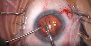 IOL Exchange Using a Posterior Capsulorhexis for Implant Fixation - Eyetube