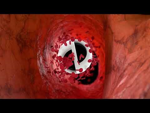 Arrow-Clark™ VectorFlow™ Chronic Hemodialysis Catheter Animation