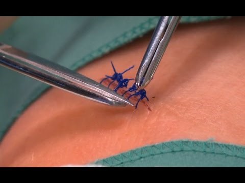 Suture Removal
