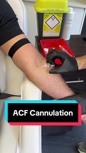 The antecubital fossa (ACF) is the area on the inner elbow commonly used for intravenous (IV) cannulation or blood sampling. It’s often chosen because the veins here — typically the median cubital, cephalic, or basilic veins — are large, visible, and relatively easy to access. #cannulate #iv #hospital #medical #phlebotomy