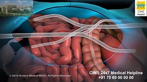 Hyperthermic intraperitoneal chemotherapy (HIPEC) - CIMS Hospital and CIMS Foundation as a part of public education for health awareness bring to you a series of short educational movies. If you like the video please SHARE with friends and family. Hyperthermic intraperitoneal chemotherapy (HIPEC) is a cancer treatment and it involves filling the abdominal cavity with chemotherapy drugs that have been heated. Also known as ¡°hot chemotherapy,¡± HIPEC is performed after the surgeon removes tumors 
